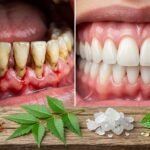 Hilte Hue Dant Majboot Karne Ke Upay: Danto Ka Hilna Kaise Roke? Masudo Ka Katna (Receding Gums) Aur Dhile Danto Ka 100% Ayurvedic Ilaj (हिलते हुए दांत मजबूत करने के घरेलू उपाय)